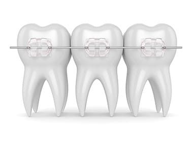 Keramikbrackets
